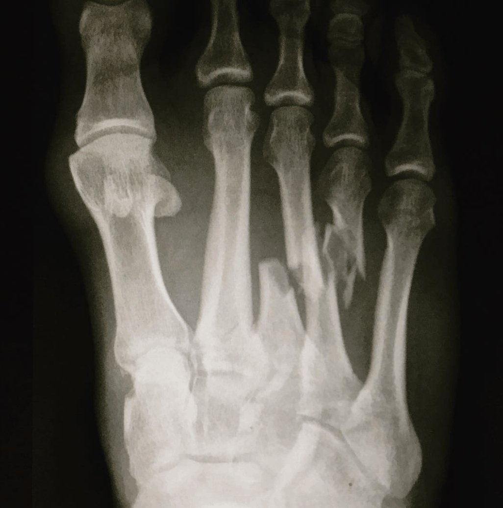 Las lesiones clásicas del surfista 2 lesion pie