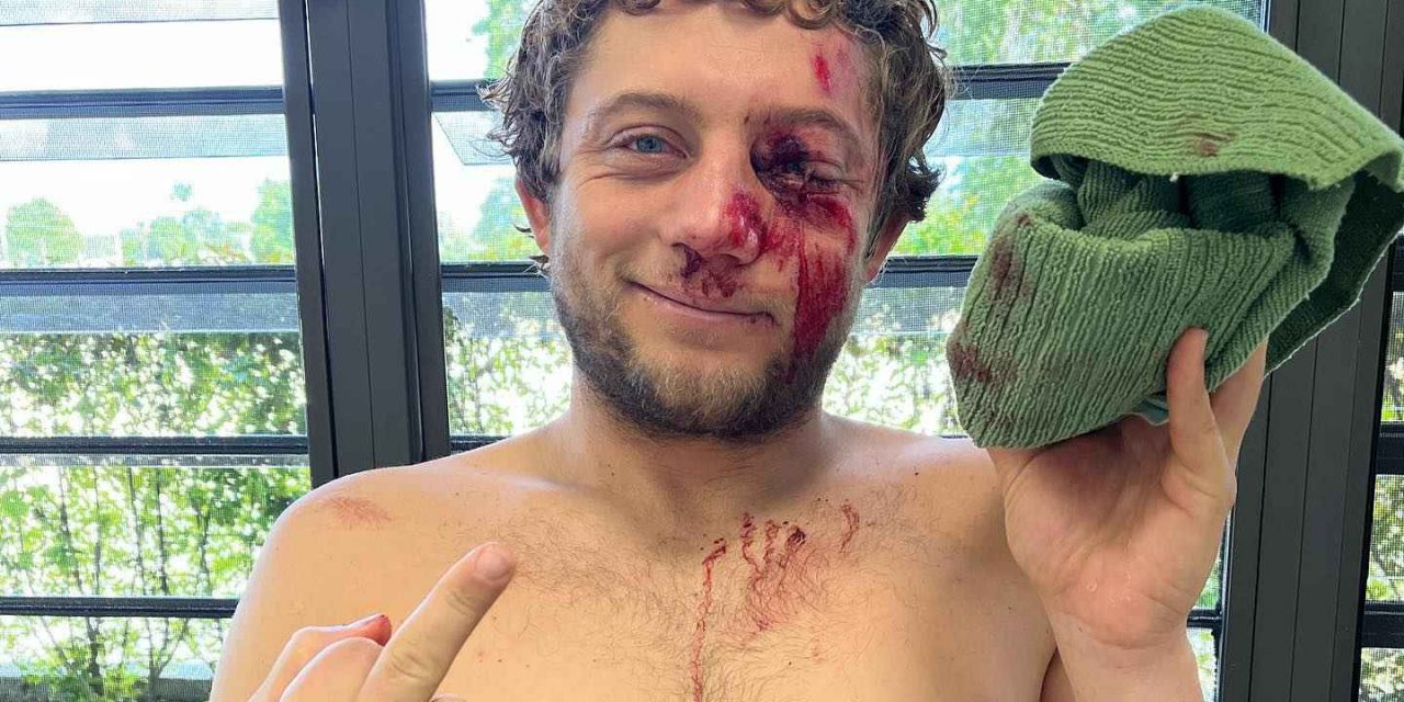 El surfista Parker Coffin sufre un grave accidente en Barbados